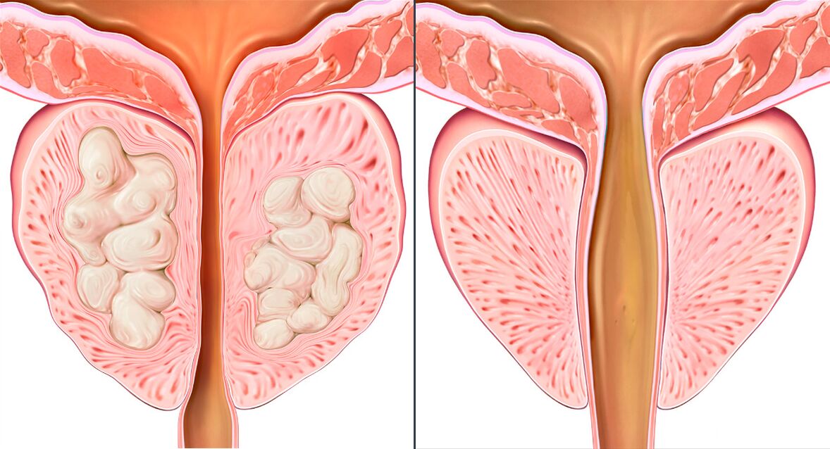 Stadien des Verlaufs der Prostatitis-Behandlung mit Prostalix.
